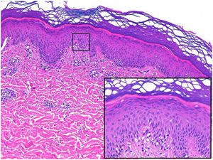 Histological section in which spongiosis (black box) is evident.