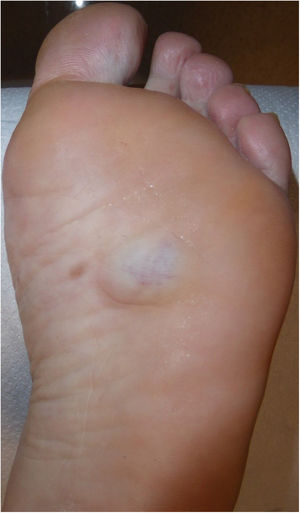 Clinical image showing a bluish nodular lesion of approximately 3 cm in size.