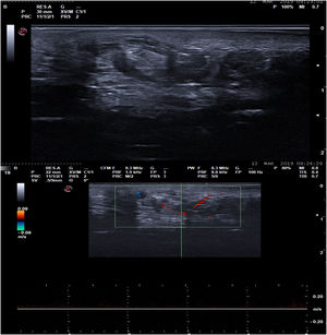 A, B-mode ultrasound image showing a poorly delimited, largely hypoechoic lesion containing tubular hypoechoic structures and scattered hyperechoic areas. B, Spectral Doppler ultrasound image, showing focal intralesional hypervascularization corresponding to high-flow, low-resistance vessels.