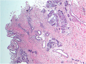 Histopathology image (hematoxylin-eosin, original magnification ×10) showing proliferation of eccrine structures in the deep dermis, dilated capillaries, and foci of adipose tissue.