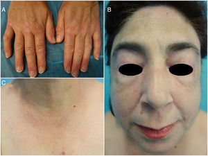 Skin lesions after 7 months of tofacitinib therapy. A, Flattening of Gottron papules and disappearance of periungual erythema. B, Discrete heliotrope erythema. C, Poikiloderma on the chest with no evidence of V sign.