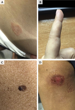 Images sent via the app. A, Pityriasis rosea. B, Scabies. C, Pigmented lesion requiring assessment by dermoscopy. D, Impetigo.