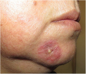 Infiltrated erythematous plaque with edematous edges, and open comedones and milium cysts.