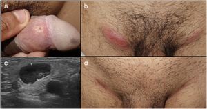 Patient 3 with painful genital ulcer on the inner face of the foreskin (a) associated with painful bilateral inflammatory adenopathy in the groin (b). Ultrasound of the groin showed greatly enlarged lymph nodes with cortical asymmetry and limited vascularization. After treatment with doxycycline 100 mg every 12 hours for 21 days, lymph node enlargement reduced leaving a residual scar.