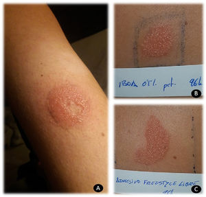A, Vesicular reaction in the area of contact with the adhesive of the FreeStyle glucose sensor, with sparing of the area in contact with the plastic. B, Positive reaction to isobornyl acrylate 0.1% pet at 96 hours. C, Positive reaction to the adhesive of the FreeStyle sensor.