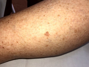 Irregular pigmented macule measuring 7 mm in a severely sun-damaged area of the left leg.