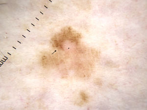 Dermoscopic image showing an irregular pigment network, light brown structureless areas, hypopigmented areas, and sparse irregularly distributed dots. Note the prominent intersecting skin markings paler in color than the rest of the lesion (arrow) and the dotted vessels in the hypopigmented areas (asterisk).