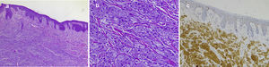 Typical histopathology image of a cutaneous granular cell tumor: A, Low-magnification image showing dermal proliferation of cells with a granular cytoplasm and some overlying epidermal hyperplasia (hematoxylin-eosin, original magnification, ×40). B, High-magnification image showing detail of the granular cells (hematoxylin-eosin, original magnification, ×200); C, Positive immunohistochemistry staining for protein S100 in granular cells (staining for protein S100 × 100).