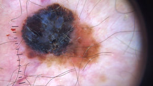 Thick melanoma with a blue-white veil, defined as an irregular, structureless area of confluent blue pigmentation with an overlying white “ground glass” film.