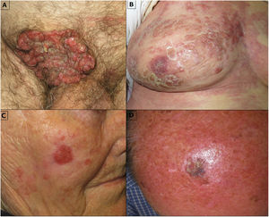 Various clinical presentations of eccrine porocarcinoma.