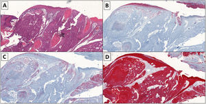 A, Histology image showing large cells with vesicular nuclei, a visible nucleolus and ample cytoplasm, cellular atypia, and numerous atypical mitoses (hematoxylin-eosin, original magnification ×4). The cells are arranged in trabeculae, cords, and nests and areas of tumor necrosis are visible. B, Immunohistochemistry image showing weak positivity (carcinoembryonic antigen, original magnification ×4). C, Immunohistochemistry image showing positive epithelial membrane antigen staining (original magnification ×4). D, Immunohistochemistry image showing positive cytokeratin (AE1/AE3) staining (original magnification ×4).