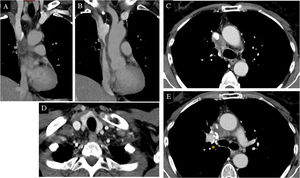 Computed tomography of the lungs in the first patient. Coronal (A and B) and axial (C-E) view of mediastinal window. An infiltrating mass can be seen, enclosing and constricting the superior vena cava from the arch of the azygos vein to where it enters the right atrium (yellow circles and arrows). Image D shows a hypodense diseased lymph node in the right supraclavicular fossa (arrow tip). Surgical clips from past right upper lobectomy (asterisk).