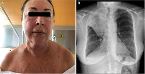Clinical and radiologic image of the second patient. A, Facial erythema and edema of the face and neck. B, Posteroanterior chest x-ray. Golden S-sign. Obstructive atelectasis of the right upper lobe in the context of a right hilar lung mass. Right pleural effusion.
