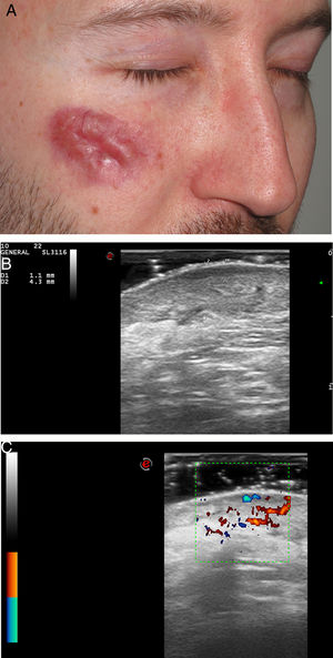 Granuloma faciale. A. Case 1: erythematous-violaceous plaque on the right cheek. B. Hypoechoic, heterogenous lesion in dermis and hypodermis, measuring 4,3 mm thick. Note the subepidermal hypoechoic band (22 MHz probe, B-mode). C. Increased vascularity on color Doppler mode.