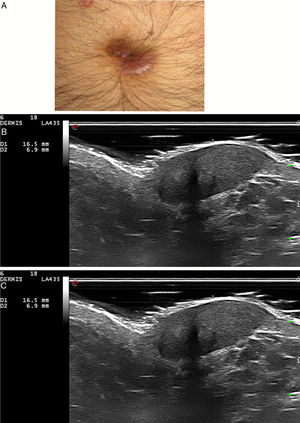 Granuloma faciale. A. Case 3: violaceous nodule on the umbilicus. B. Hypoechoic, well-defined and heterogenous lesion in dermis and hypodermis, measuring 6.9 mm thick (18 MHz probe, B-mode). C. Marked increase in vascularization (18 MHz probe, color Doppler mode).
