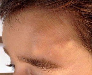 Multiple confluent stony-hard nodules in the left area of the forehead.