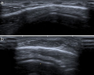 High-frequency ultrasound (12 MHz) showing poorly-defined hypoechoic nodules in the hypodermis surrounded by a hyperechoic ring and joined by a thin hyperechoic line.
