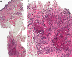 A, Hematoxylin-eosin, original magnification ×4. B, Hematoxylin-eosin original magnification ×10.