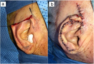 Surgical defect after resection (a). Positioning and suture of the flaps (b).