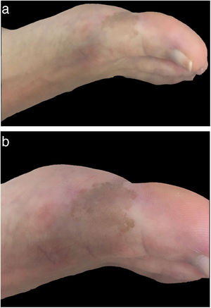 A, Brown macule with irregular contours on the inner aspect of the right hallux. B, Higher-magnification image showing a light brown lesion with irregular contours.