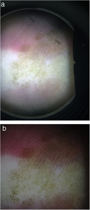 A, Parallel ridge pattern and fine peripheral dots. B, Dermoscopic image showing parallel ridge pattern, reticular pattern, and fine peripheral dots.