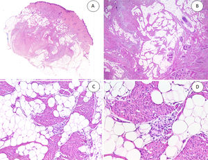 A, Fibrous hamartoma of infancy in the dermis and subcutaneous tissue. B, Higher-magnification view showing dense bands of fibrous tissue projecting into the adipose tissue. C, Interlacing trabeculae of fibrous tissue containing clusters of immature fibrocytes forming whorls. D, Immature basophilic mesenchymal component interspersed with fibrous tissue.