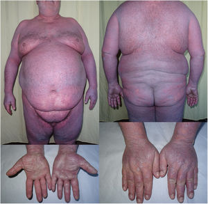Top left and right, Extensive erythematous-violaceous Dermatitis with lichenoid sheen. Bottom right, Erythematous-violaceous papules with a lichenoid sheen on the backs of the hands and fingers. Bottom left, Shiny palmar keratoderma.