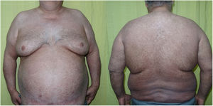 Resolution of the erythroderma after administration of 400 mg/24 h of cyclosporin A for 30 days. Residual hyperpigmentation.