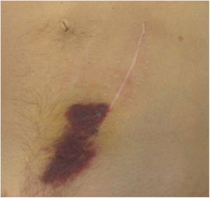 Cutaneous Kaposi sarcoma in the surgical scar.