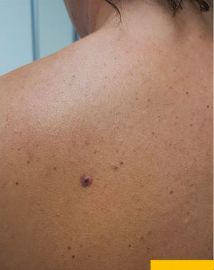 A violaceous papule surrounded by a homogeneous purpuric halo on the back of a 43-year-old woman.