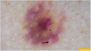 Dermoscopic image of the lesion (DermLite 4). The reddish-violaceous homogeneous lesion is surrounded by a biphasic halo. The first halo has a yellowish-orange tinge (*) and the second halo on the periphery is reddish. The hair follicles remain intact.