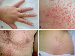 Some of the subtypes of Darier disease. A, Acral hemorrhagic Darier disease: dark red macules on the dorsum of the hand. B, Vesiculobullous type: vesicles and blisters of various sizes are present along with erythematous-keratotic papules. C, Comedonal form: comedones and cysts appear along with the typical lesions of Darier disease. D, Type 1 segmental Darier disease: involvement limited to the lines of Blaschko on the left flank.