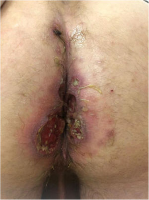 Patient 10, appearance of the perianal ulcers.