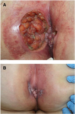 A, Patient 2, perianal ulcers on presentation. B, Resolution of the ulcers after 6 weeks.