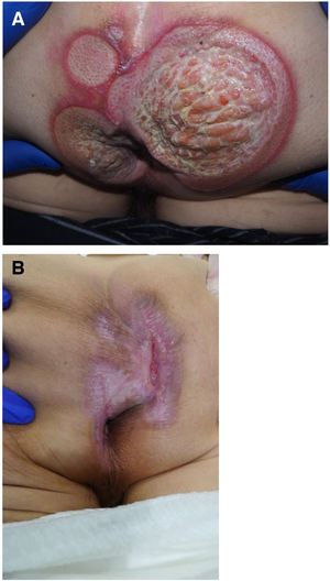 A, Patient 3, perianal ulcers on presentation. B, Complete reepithelialization of the ulcers after 3 months.