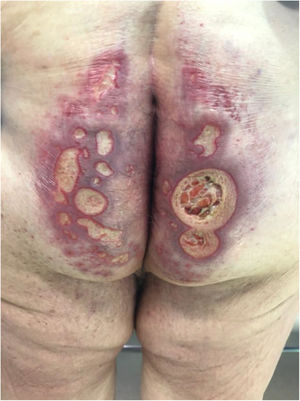 Patient 4, perianal ulcers on presentation.