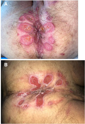 A, Patient 6, perianal ulcers on presentation. B, Improvement 2 weeks after discontinuing application of the hemorrhoid ointment.