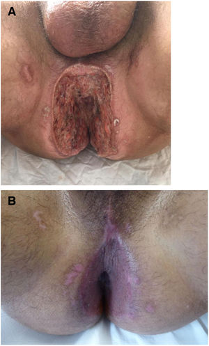 A, Patient 7, perianal ulcers on presentation. B, Complete reepithelialization was achieved after partial skin grafts were placed.