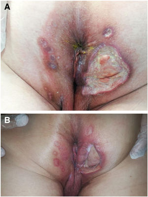 A, Patient 8, perianal ulcers on presentation. B, Signs that the ulceration has improved and resolution is nearly complete after 5 months without the hemorrhoid ointment.