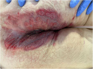 Patient 9, appearance of the perianal ulcers.