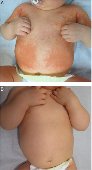 A, Initial clinical picture: multiple salmon-pink plaques on the trunk and both arms. B, Complete response after 4 weeks of topical corticosteroid treatment.