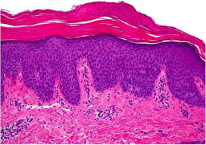 Orthokeratosis alternating with foci of parakeratosis (hemoxylin eosin, original magnification ×40). The epidermis shows regular acanthosis and psoriasiform hyperplasia, and scarce inflammatory infiltrate is evident in the dermis.