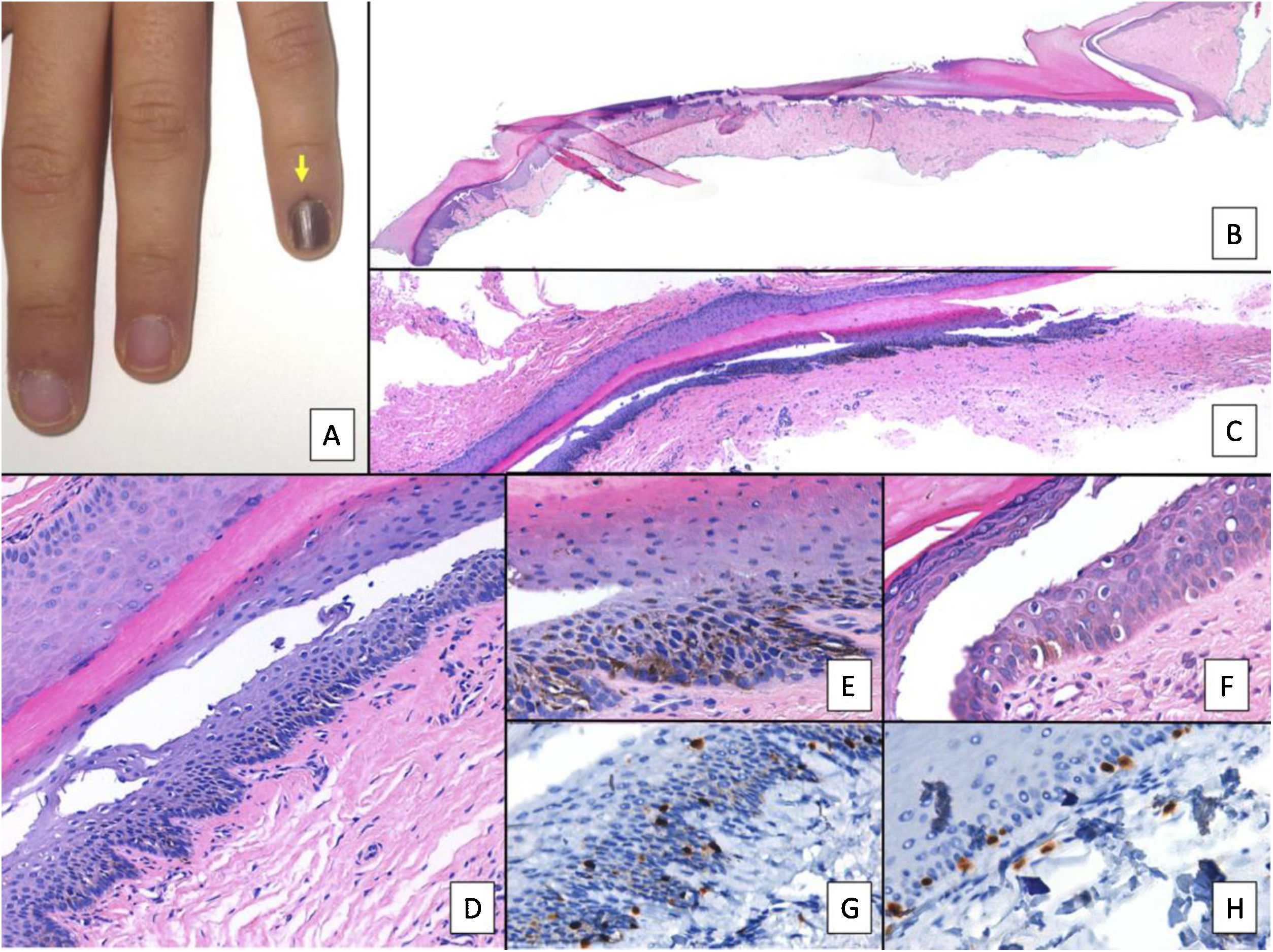 Successful treatment of onychomatricoma with minimally invasive surgical  procedures based on its pathogenesis: A case report - Miyamoto - The  Journal of Dermatology - Wiley Online Library