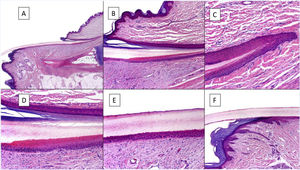 Histological anatomy of a normal nail. A, Microscopic anatomy of a normal nail in a longitudinal section. B, Detail of the nail matrix and eponychium. C, Fold between the proximal matrix and the eponychium. D, In the lower part, typical keratinization can be seen without any granular layer of the matrix to form the plate with a similar aspect to trichilemmal keratinization. In the upper part, the eponychium can be seen with characteristic orthokeratotic keratinization. E, Detail of the nail bed with its typical flattened epidermis without the stratum granulosum covered directly by the nail plate. F, Detail of the hyponychium with an epidermis with orthokeratotic keratinization with similar characteristics to that of the rest of normal acral skin (not subungual).