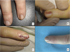 Longitudinal excision biopsy of the nail apparatus. A, Pale brown longitudinal melanonychia, which histologically corresponds to nail hypermelanosis. B, Under local anesthetic, longitudinal excision is performed in a cylindrical shape from the proximal nail fold to the hyponychium, including the entire nail apparatus. C, Direct closure of the defect by suture from nail plate at the surface to the deep nail connective tissue. D, After 1 year, the result is a normal nail without any sign of permanent dystrophy, just narrower.