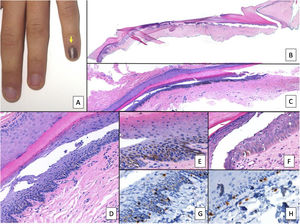 Subungual Melanocytic Lesions: Key Clinical and Pathologic Concepts and  Biopsy Techniques