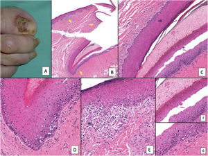 Subungual melanoma. A, Pigmented subungual lesion that generates substantial nail dystrophy, with partial destruction of the nail plate. An evident pigmentation of the exposed bed can be seen, in the hyponychium and the proximal nail fold (Hutchinson sign). B, Low-magnification view of longitudinal nail biopsy (x4), in which an increase in the pigment of the matrix can be seen, as well as sparse foci of accompanying inflammatory infiltrate (arrows). C, Greater detail (x100) of the nail matrix shows a lentiginous proliferation of vacuolated cells (melanocytes), with marked suprabasal ascent; cells thus even become incorporated into the nail plate. This lentiginous proliferation also involves the eponychium. D, At higher magnification (x200), a proliferation of atypical melanocytes can be observed, with suprabasal ascent with invasion of the entire matrix and spread towards the eponychium. E, Detail (x200) of the proximal nail fold. Melanocytic proliferation has now spread to the skin proximal to the eponychium. Once again, a lentiginous proliferation of atypical melanocytes is observed, with presence of atypical cells already in the papillary dermis and accompanying inflammatory infiltrate. Therefore, this melanoma is initially invasive. F, Detail (x200) of the suprabasal ascent of atypical cells, some of which are present in the nail plate. G, Detail (x200) of the nail matrix; ascent to suprabasal layers of atypical melanocytes.