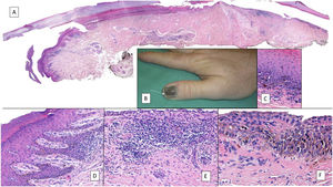 Subungual melanoma. A, Low-magnification longitudinal view of the entire nail apparatus. The patches of inflammatory infiltrate of irregular distribution are already apparent at low magnification of the distal matrix, nail bed, and also in the hyponychium. B, In the clinical image, an irregular and complete melanonychia is shown of the nail of the right thumb. Of note is the punctual pigmentation of the hyponychium (arrow). C, Detail of the matrix with melanocytes with evident atypia (arrow). D, Detail of the hyponychium with proliferation of atypical melanocytes in the basal layer and lymphocyte infiltrate at the base of the epidermal ridge. E, Detail of a nail bed with patchy lymphocyte infiltrate beneath a basal epidermal layer with increased number of melanocytes. F, Detail of the nail matrix with proliferation of atypical melanocytes that are present throughout the full thickness of the nail epithelium.