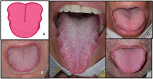 Characteristic tongue swelling or macroglossia (6.6%) associated with transient U-shaped lingual papillitis (11.5%) in patients with COVID-19. A, Illustration showing tongue changes with indentation on both sides of the tongue and inflammation of anterior papillae, probably caused by friction. B–E, Tongue swelling and transient U-shaped lingual papillitis during COVID-19. COVID-19 indicates coronavirus disease 2019.