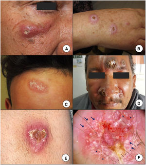A–C, The presence of an erythematous papule or nodule exhibiting progressive growth and a tendency to ulcerate in exposed areas, such as the face or extremities, is the most characteristic presentation of cutaneous leishmaniasis. D, Some patients have multiple lesions, or atypical presentations such as the verrucous lesion in this patient with New World cutaneous leishmaniasis. Clinical (E) and dermoscopic (F) image of a cutaneous leishmaniasis lesion on the forearm showing central ulceration surrounded by an erythematous area with peripheral polymorphous and hairpin vessels (asterisks) and white-yellow teardrop-like structures (arrows)(polarized light, original magnification ×10). Images courtesy of Dr. Morales Moya (2C), Dr. Galimberti (2D), and Dr Mayo Martínez (2E and F).